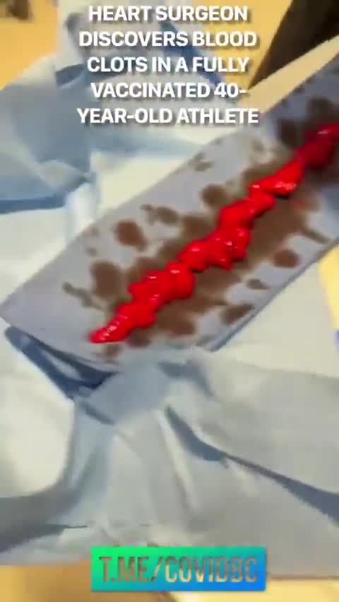 Heart Surgeon Discovers Blood Clots In A Fully Vaccinated 40-Year-Old Athlete