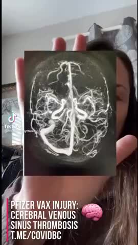 SUFFERED A HORRIFIC BRAIN INJURY AFTER TWO PFIZER VACCINES!