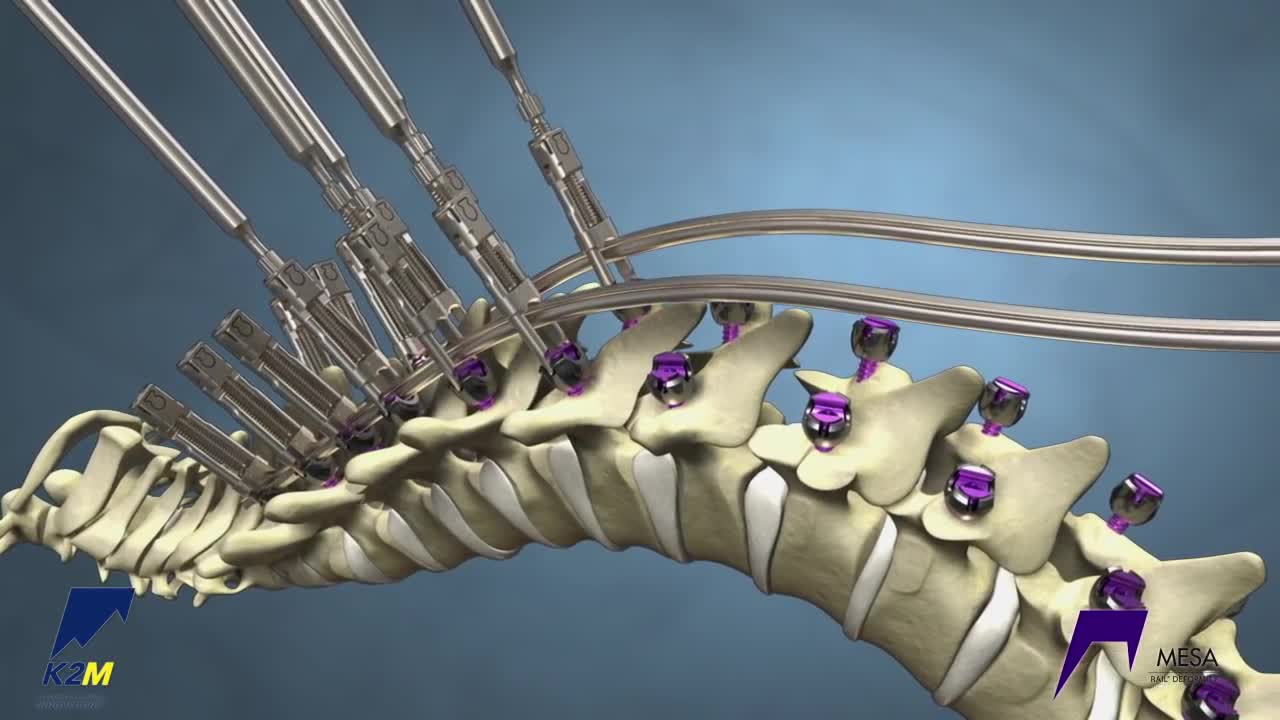 Correcting Kyphosis with the MESA Rail™ Deformity Spinal System