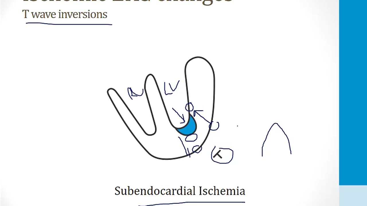 Cardiology - 2. Cardiac Ischemia - 2.Cardiac Ischemia