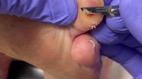 Very large corn and callus on tip of toe removal by Australian podiatrist