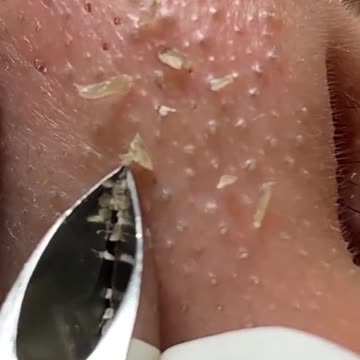 Satisfying removal of whiteheads on nose
