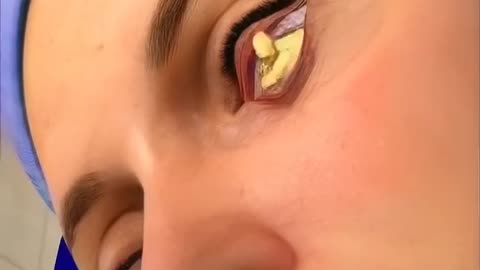 Blepharoplasty 😵