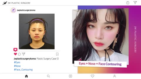 Korean plastic surgery real before and after pictures