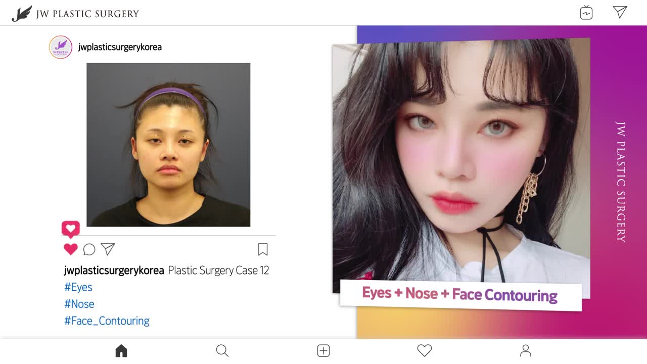 Korean plastic surgery real before and after pictures