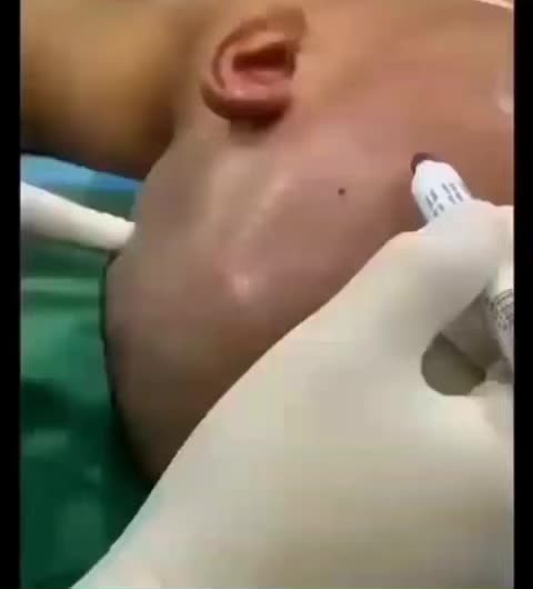 WARNING GRAPHIC: VACCINE CAUSES MASSIVE BLOOD CLOTS IN THE BRAIN