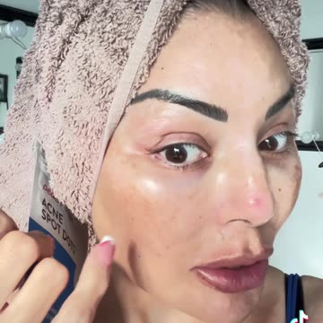 I am amazed how this little acne patch took away my pimple. And it’s inexpensive.