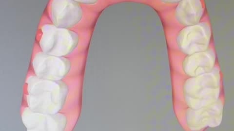 Invisalign 11 tray journey