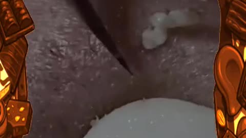 Cleaning comedones Part 6