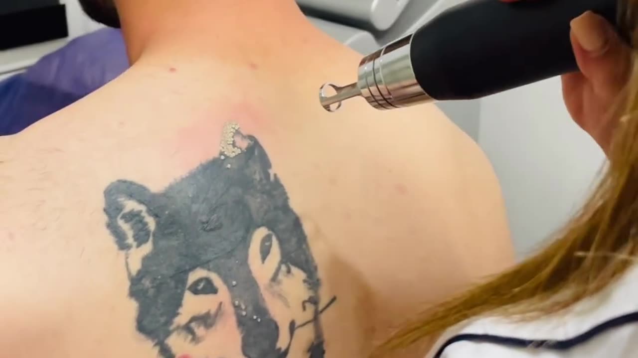 Removing body tattoos with a laser machine!!