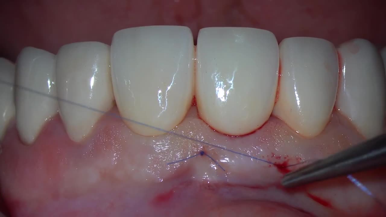 Connective tissue graft for pontic site development