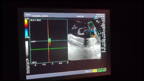 Gender Female At 34 week l No cord around neck l primigravida l 18 years old