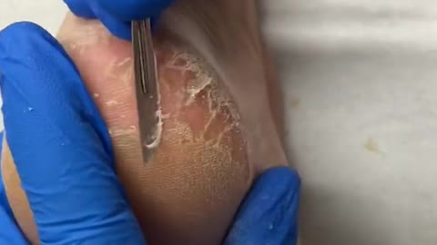 Thick Painful heel callus removal by Australian podiatrist