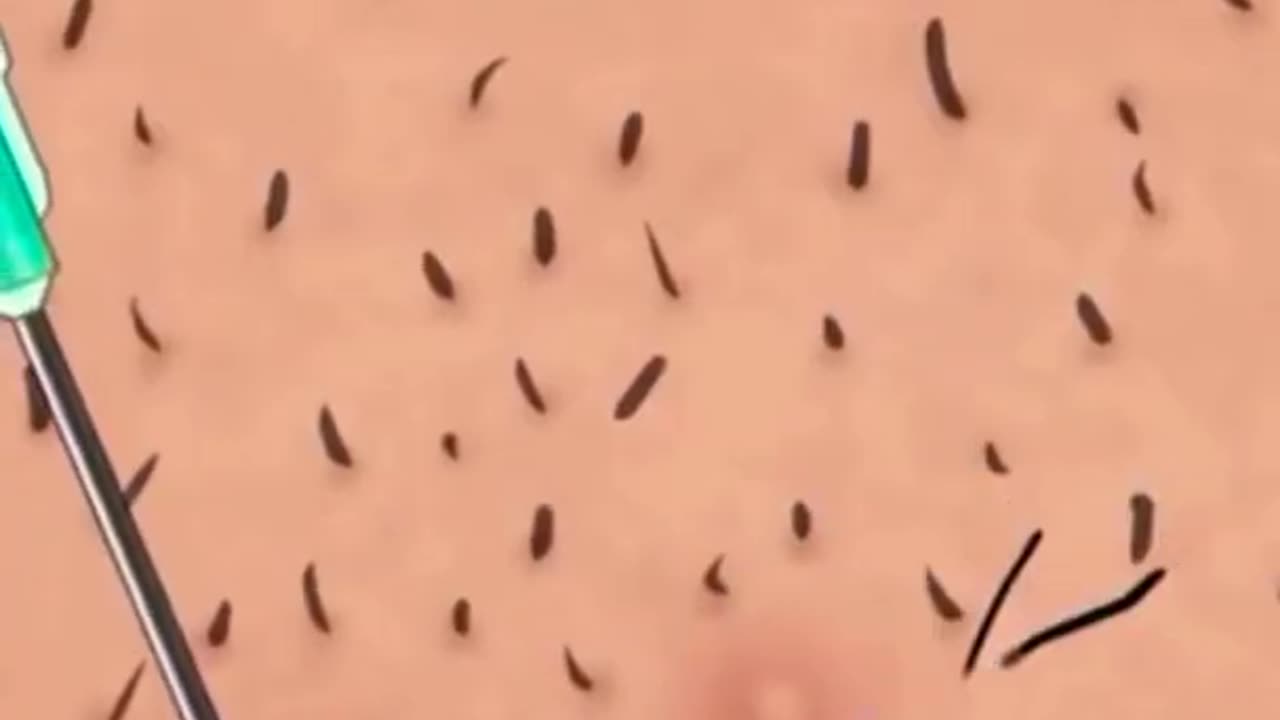 [ ASMR ] Ingrown Hair Removal | Satisfying Skincare Animation #short