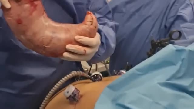 Look what the doctor pulled out of his stomach