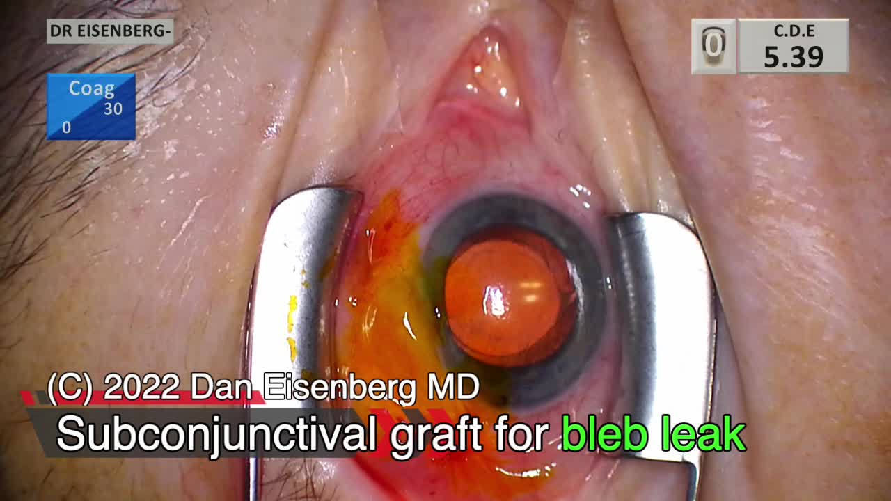 Glaucoma bleb leak repair with subcojunctival graft