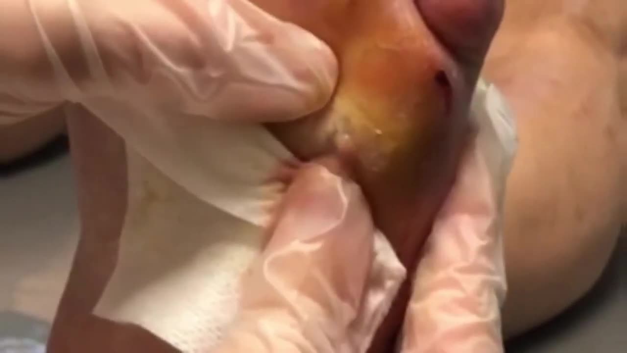 EXPLODING ABSCESS 😣