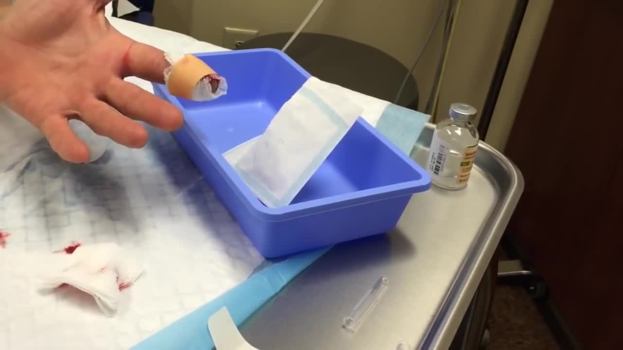 Finger Infection gets drained