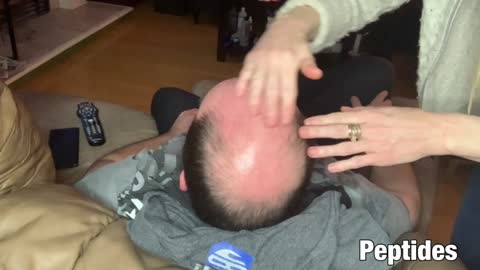 MICRONEEDLING Hair Growth / Injectable