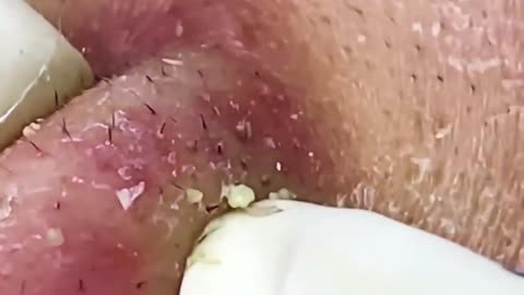 BIG Blackheads Removal , Acne Treatment ,SPA ASMG , Blackheads on face