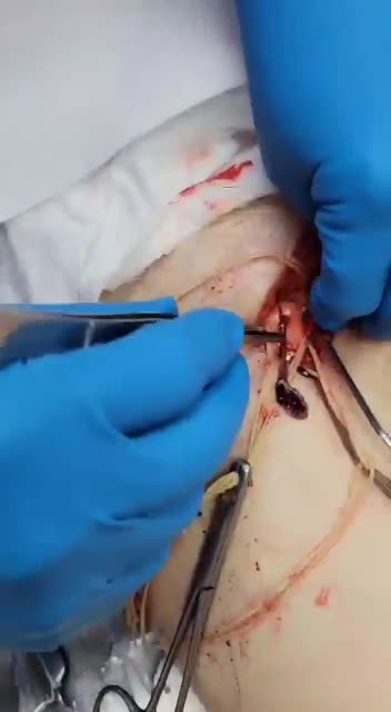 nanoparticle tube-clots in iliac artery from the vaccines