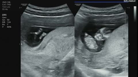 pregnant / 12w3d (4monthspregnant) / the sole of foot