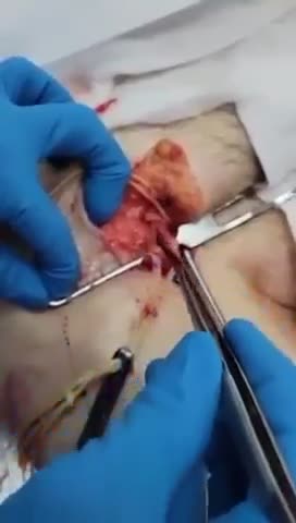 #JAB BLOOD CLOTS! NOT NORMAL @ ALL! AND THIS IS A SMALL ONE COMPARED TO SOME THAT I HAVE SEEN IN THE PAST YEAR!