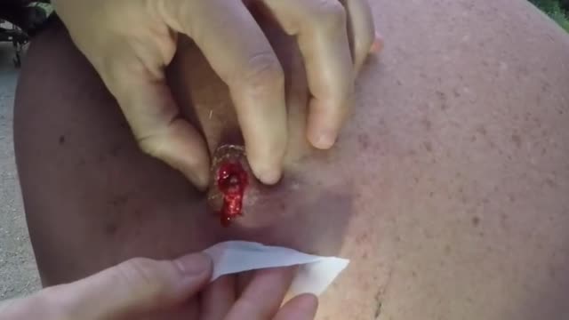 Giants Deep Blackheads, Whiteheads, Big Pimples, Hidden Acne Removal - Best Popping Videos #000031