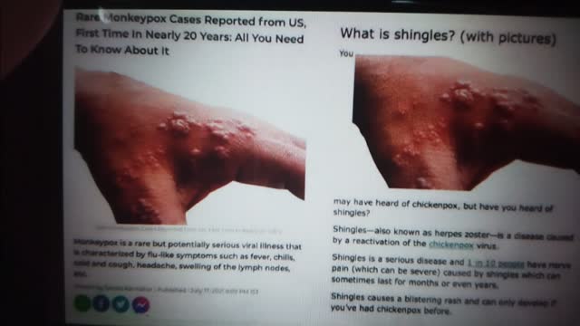 Monkeypox pics same as Shingles pics why is the News is Fake.