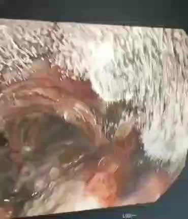 broncoscopia (endoscopia a tráquea y bronquios) en infeccion por hongo aspergillus