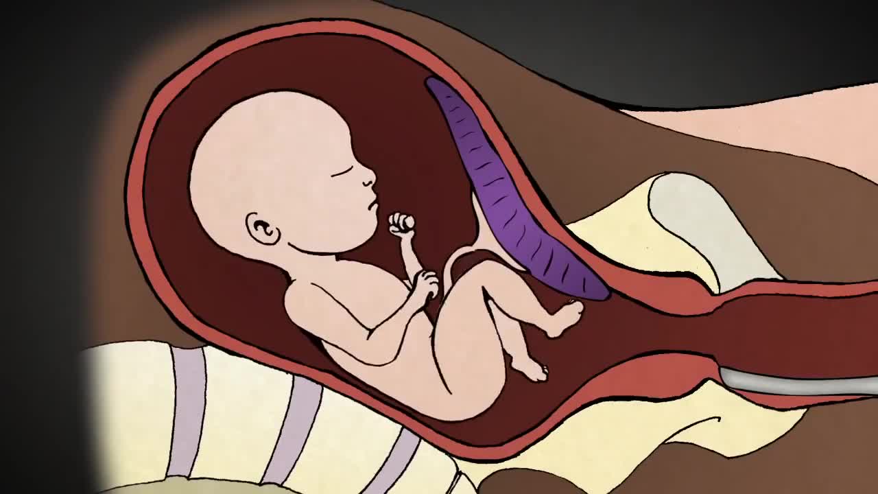 Youtube Continues Removing: "2nd Trimester Surgical Abortion Dilation and Evacuation D E"