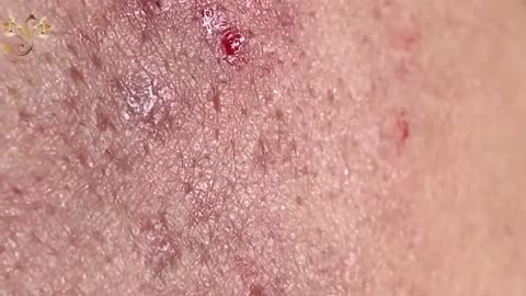 #122 | Acne Treatment Huong beauty