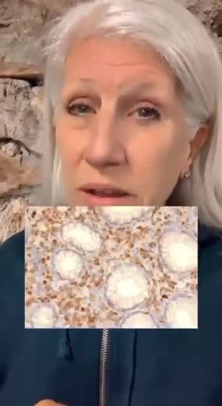 VAX Spike Proteins Found In Cancer Cells.