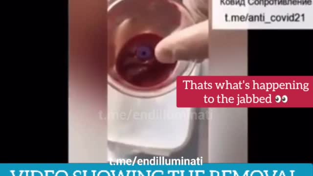 (Warning: Graphic) Cupping the Vax 30 Mins after Injection