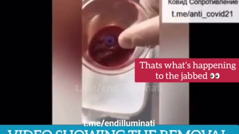 (Warning: Graphic) Cupping the Vax 30 Mins after Injection