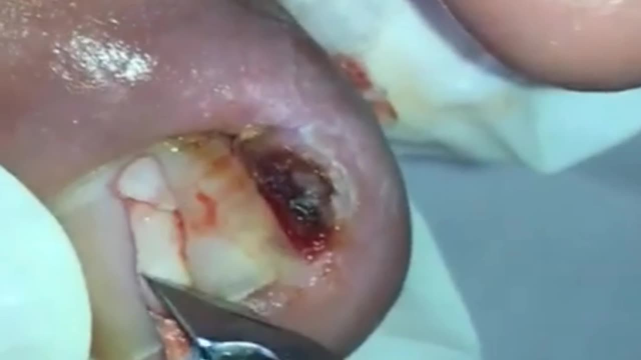 Ingrown toenail removal