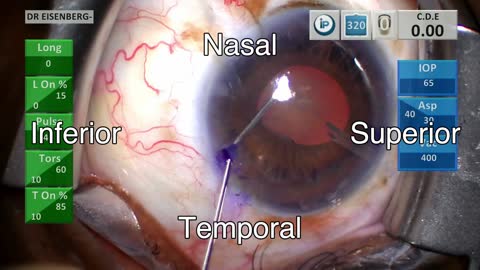 Complex cataract after glaucoma shunt surgery