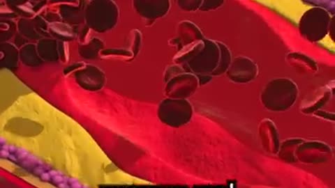 Cholesterol Plaque Removed