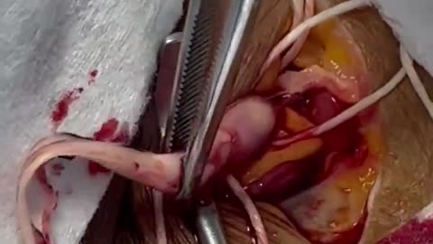 White Fibrous Clots being pulled out by an embalmer