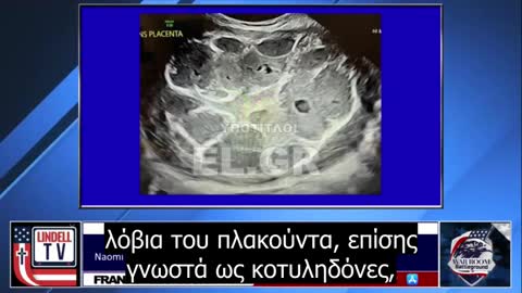 Η Naomi Wolf μοιράζεται φωτογραφίες πλακούντα μετά τον εμβολιασμό για τον COVID-19