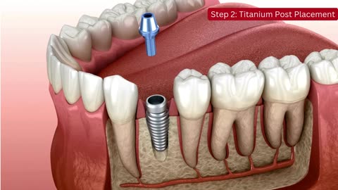 Dental Implant Procedure | Best Dental Clinic in Bannerghatta Raod | Best Dentist in Bangalore