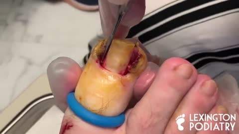 DEEP + BLOODY INGROWN TOE NAIL