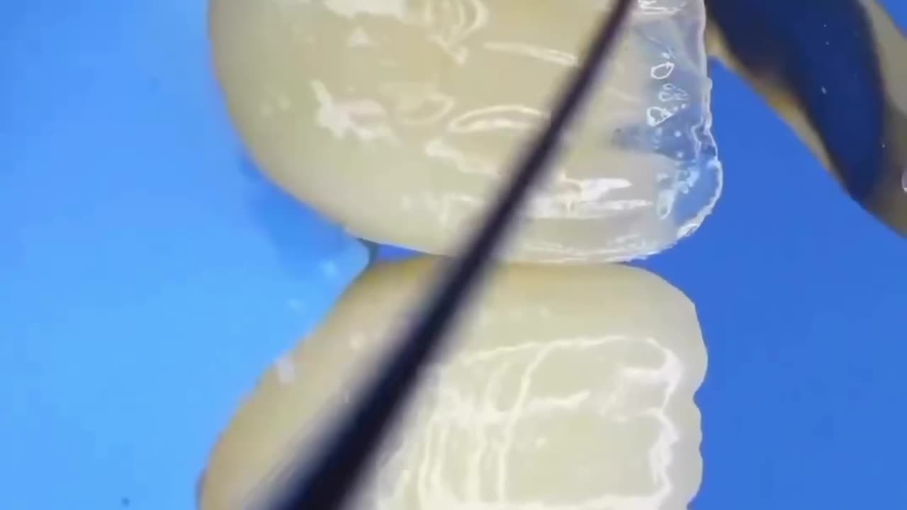 Dentist cleans and restores the tooth