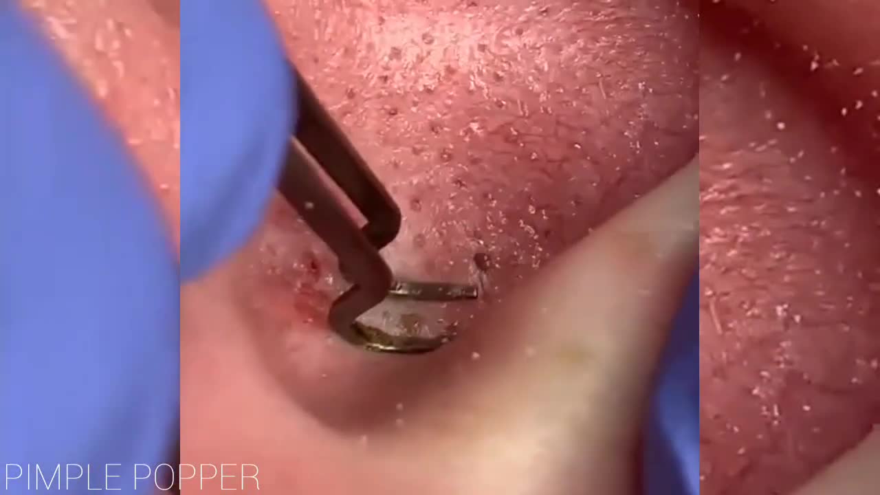 Satisfying Ear Pimple Popping Videos