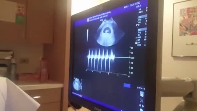 Fetal Heart Beat Detected- CALLING DR. STACY ABRAMS!