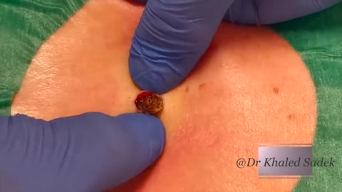 3 yr old black head removed!