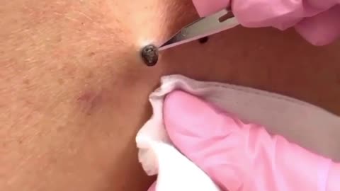 huge blackhead being pulled out of a face