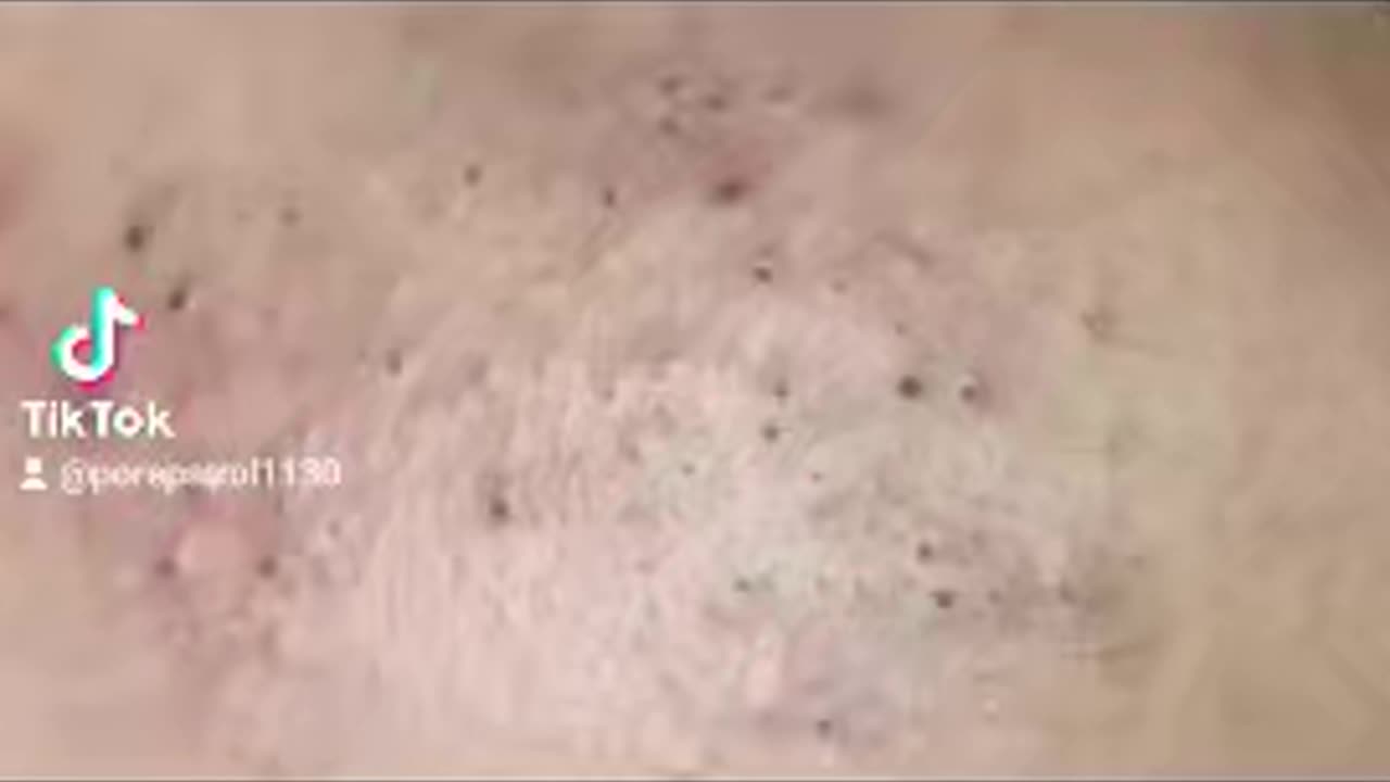 Satisfying Blackheads Removal.