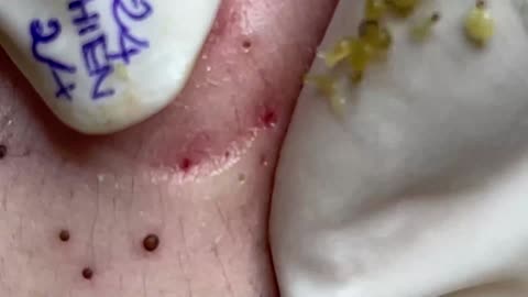 Blackhead Extraction Cleansing!