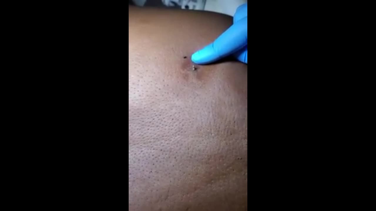 pop that blackhead